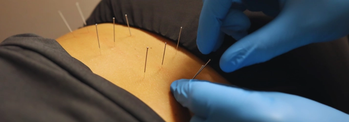 Chiropractic Towson MD Dry Needling