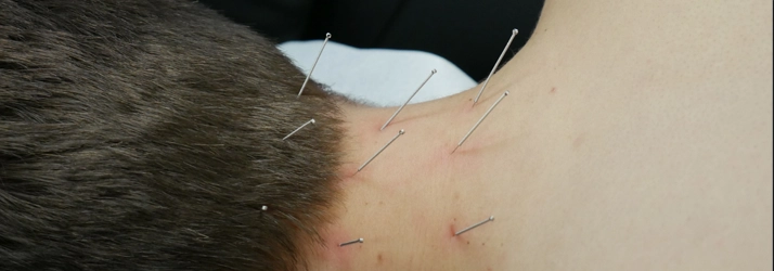 Chiropractic Towson MD Needles In Neck